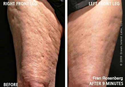 Fran Rosenberg - age 70