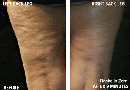 Rochelle Zorn - age 45